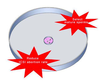 ICSI IVF를 위한 Hyaluronic 산 정액 선택 접시는 임신 손실 비율을 감소시킵니다